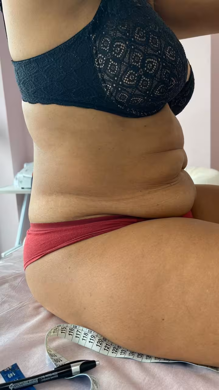 Antes - Diástase abdominal